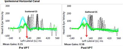 Improvement After Vestibular Rehabilitation Not Explained by Improved Passive VOR Gain